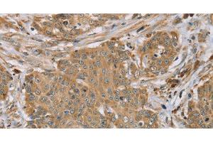 Immunohistochemistry of paraffin-embedded Human cervical cancer tissue using RNF148 Polyclonal Antibody at dilution 1:45 (RNF148 antibody)
