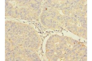 Immunohistochemistry of paraffin-embedded human endometrial cancer using ABIN7148571 at dilution of 1:100 (CIR1 antibody  (AA 1-160))