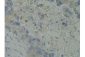 IHC-P analysis of Human Breast Cancer Tissue, with DAB staining. (BMX antibody  (AA 287-523))