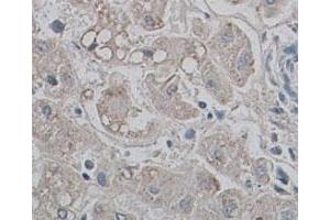 Immunohistochemical staining of formalin-fixed paraffin-embedded human liver tissue showing membrane staining with AQP9 polyclonal antibody  at 1 : 100 dilution. (AQP9 antibody  (N-Term))