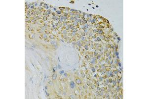 Immunohistochemistry of paraffin-embedded human esophageal cancer using GPX4 Antibody (ABIN5970997) at dilution of 1/200 (40x lens).