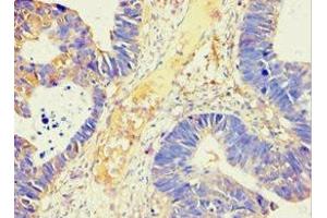 Immunohistochemistry of paraffin-embedded human ovarian cancer using ABIN7143846 at dilution of 1:100 (AMY2B antibody  (AA 16-320))