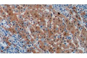 Detection of ARG in Human Liver cancer Tissue using Monoclonal Antibody to Arginase (ARG) (ARG antibody  (AA 1-322))