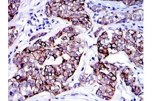 Immunohistochemical analysis of paraffin-embedded human bladder cancer tissues using KRT19 mouse mAb with DAB staining. (Cytokeratin 19 antibody)