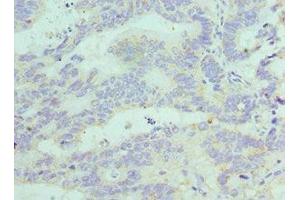 Immunohistochemistry of paraffin-embedded human colon cancer using ABIN7152772 at dilution of 1:100 (FGF1 antibody  (AA 16-155))