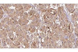 ABIN6269002 at 1/100 staining Human Melanoma tissue by IHC-P. (COL2A1 antibody  (N-Term))