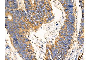 ABIN6259147 and ABIN6274943 at 1/100 staining Human colorectal cancer by IHC-P.