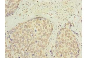 Immunohistochemistry of paraffin-embedded human gastric cancer using ABIN7145334 at dilution of 1:100 (SLC22A18AS antibody  (AA 1-150))