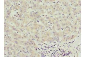 Immunohistochemistry of paraffin-embedded human liver cancer using ABIN7146346 at dilution of 1:100 (CALCOCO1 antibody  (AA 462-691))