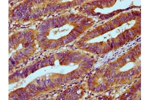 IHC image of ABIN7168103 diluted at 1:300 and staining in paraffin-embedded human colon cancer performed on a Leica BondTM system. (Ribonuclease H1 antibody  (AA 73-185))