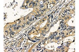 ABIN7095313 and ABIN7099370 at 1/100 staining human pancreatic cancer by IHC-P. (C2CD2 antibody)