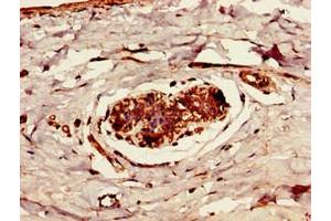 Immunohistochemistry of paraffin-embedded human breast cancer using ABIN7174362 at dilution of 1:100