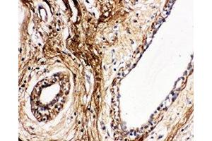 IHC-P: Protein C antibody testing of human breast cancer tissue (PROC antibody  (AA 446-461))