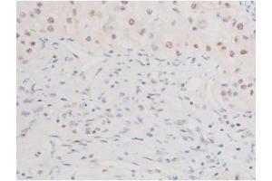 ABIN6267579 at 1/200 staining Human kidney cancer tissue sections by IHC-P. (FOXO4 antibody  (pSer197))