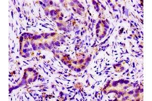 Immunohistochemistry of paraffin-embedded human pancreatic cancer using ABIN7161093 at dilution of 1:100 (SLC11A2 antibody  (AA 1-69))