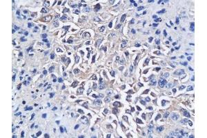 Formalin-fixed and paraffin embedded mouse hepatic tumor labeled with Anti-CD150/SLAMF1 Polyclonal Antibody, Unconjugated followed by conjugation to the secondary antibody and DAB staining