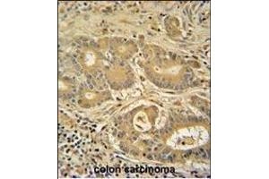 IT Antibody (C-term) (ABIN389476 and ABIN2839538) iunohistochemistry analysis in formalin fixed and paraffin embedded human colon carcinoma followed by peroxidase conjugation of the secondary antibody and DAB staining. (IMMT antibody  (C-Term))