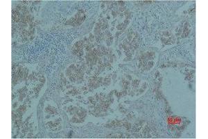 Immunohistochemistry (IHC) analysis of paraffin-embedded Human Lung Carcicnoma using Catenin-beta Monoclonal Antibody. (beta Catenin antibody)