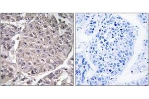 Immunohistochemistry analysis of paraffin-embedded human liver carcinoma tissue, using APOL4 Antibody. (Apolipoprotein L 4 antibody  (AA 301-350))