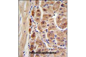 ALDH1A1 Antibody IHC analysis in formalin fixed and paraffin embedded human hepatocarcinoma followed by peroxidase conjugation of the secondary antibody and DAB staining. (ALDH1A1 antibody)