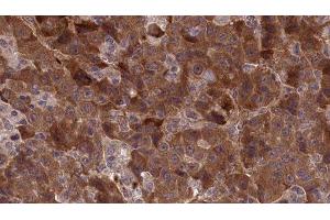 ABIN6277306 at 1/100 staining Human liver cancer tissue by IHC-P. (APLP1 antibody  (Internal Region))