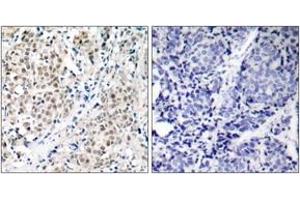 Immunohistochemistry analysis of paraffin-embedded human breast carcinoma tissue, using MYC (Ab-358) Antibody. (c-MYC antibody  (AA 325-374))