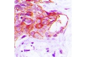 Immunohistochemical analysis of CADM2 staining in human prostate cancer formalin fixed paraffin embedded tissue section. (CADM2 antibody)
