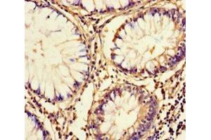 Immunohistochemistry of paraffin-embedded human colon cancer using ABIN7165430 at dilution of 1:100 (FAM161A antibody  (AA 1-300))