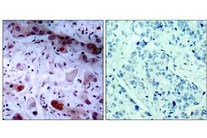 Immunohistochemical analysis of paraffin-embedded human breast carcinoma tissue, using JAK1 (phospho-Tyr1022) antibody (E011149). (JAK1 antibody  (pTyr1022))