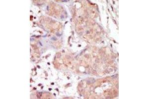 Formalin-fixed and paraffin-embedded human cancer tissue reacted with the primary antibody, which was peroxidase-conjugated to the secondary antibody, followed by DAB staining. (MAK antibody  (C-Term))