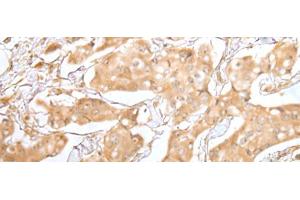 Immunohistochemistry of paraffin-embedded Human breast cancer tissue using GRAP Polyclonal Antibody at dilution of 1:40(x200) (GRAP antibody)