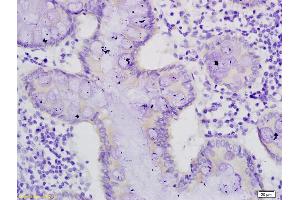 Formalin-fixed and paraffin embedded human colon cancer labeled with Anti-mucin3/Muc3 Polyoclonal Antibody, Unconjugated (ABIN687772) at 1:200 followed by conjugation to the secondary antibody and DAB staining (MUC3A antibody  (AA 1501-1600))