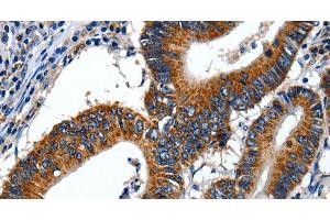 Immunohistochemistry of paraffin-embedded Human colon cancer using LAMA1 Polyclonal Antibody at dilution of 1:70 (Laminin alpha 1 antibody)