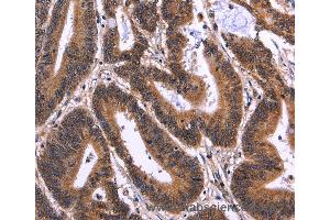 Immunohistochemistry of Human cervical cancer using MSH4 Polyclonal Antibody at dilution of 1:50