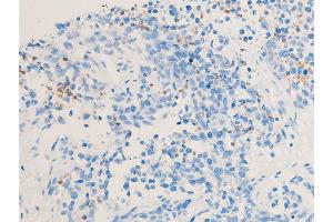 ABIN6255167 and ABIN6267222 at 1/100 staining rat cancer tissue sections by IHC-P.