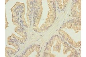Immunohistochemistry of paraffin-embedded human prostate cancer using ABIN7165562 at dilution of 1:100