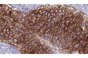 ABIN6275913 at 1/100 staining Human urothelial cancer tissue by IHC-P. (Adenosine A2a Receptor antibody  (Internal Region))