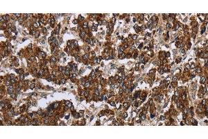 Immunohistochemistry of paraffin-embedded Human liver cancer using PPP1R13L Polyclonal Antibody at dilution of 1:30 (PPP1R13L antibody)