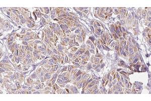 ABIN6277153 at 1/100 staining Human Melanoma tissue by IHC-P.
