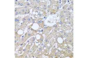 Immunohistochemistry of paraffin-embedded human liver injury using TUBGCP3 antibody at dilution of 1:100 (x40 lens).