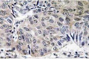 Immunohistochemistry (IHC) analyzes of S-100A10 antibody in paraffin-embedded human lung carcinoma tissue. (S100A10 antibody)