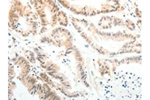 The image on the left is immunohistochemistry of paraffin-embedded Human colon cancer tissue using ABIN7189608(ABL2 Antibody) at dilution 1/25, on the right is treated with synthetic peptide. (ABL2 antibody)