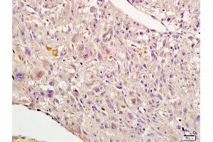 Formalin-fixed and paraffin embedded human endometrial cancer labeled with Rabbit Anti-Nrf2 Polyclonal Antibody, Unconjugated (ABIN737271) 1:200 followed by conjugation to the secondary antibody and DAB staining (NRF2 antibody  (AA 430-480))