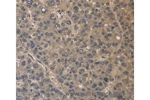 Immunohistochemistry of Human liver cancer using DRG1 Polyclonal Antibody at dilution of 1:30