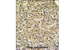 Merlin Antibody IHC analysis in formalin fixed and paraffin embedded human lung carcinoma followed by peroxidase conjugation of the secondary antibody and DAB staining. (Merlin antibody  (N-Term))
