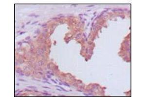 Immunohistochemical analysis of paraffin-embedded human prostate carcinoma tissues, showing cytoplasmic localization using KLK3 mouse mAb with DAB staining.
