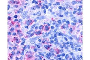 Anti-CYSLTR1 / CYSLT1 antibody IHC of human Lymph Node, Hodgkins Lymphoma. (CysLTR1 antibody  (Extracellular Domain))