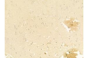 ABIN6261919 and ABIN6278467 at 1/100 staining human glioblastoma by IHC-P.