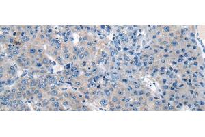 Immunohistochemistry of paraffin-embedded Human liver cancer tissue using CITED4 Polyclonal Antibody at dilution of 1:65(x200) (CITED4 antibody)