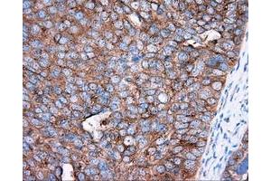 Immunohistochemical staining of paraffin-embedded Adenocarcinoma of colon tissue using anti-PRKAR2A mouse monoclonal antibody. (PRKAR2A antibody)